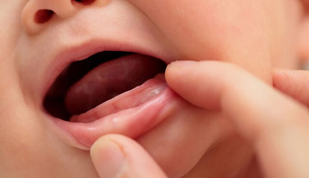 Cách chăm sóc sốt mọc răng ở trẻ và chế độ dinh dưỡng cần thiết